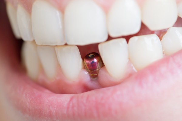 Les implants dentaires et le diabète