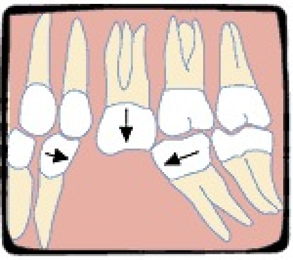 Les prothèses dentaires au cabinet dentaire bezons.