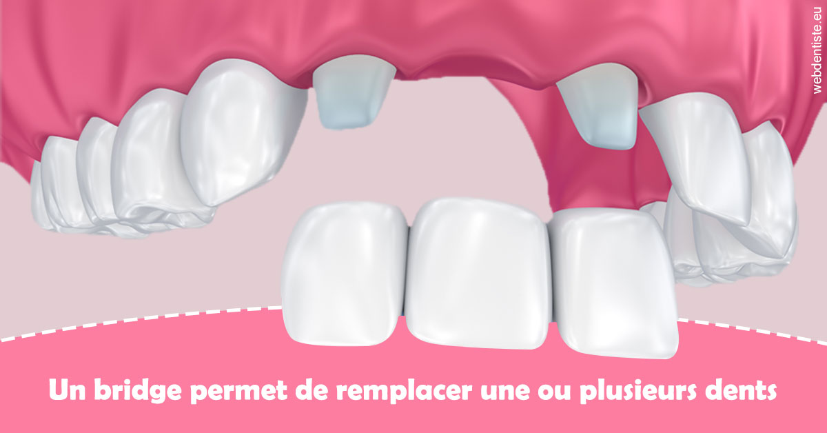 https://dr-maarek-jonathan.chirurgiens-dentistes.fr/Bridge remplacer dents 2