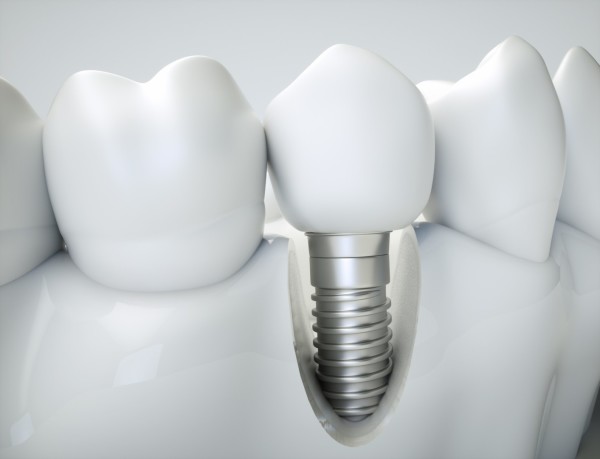 Les implants dentaires : généralités