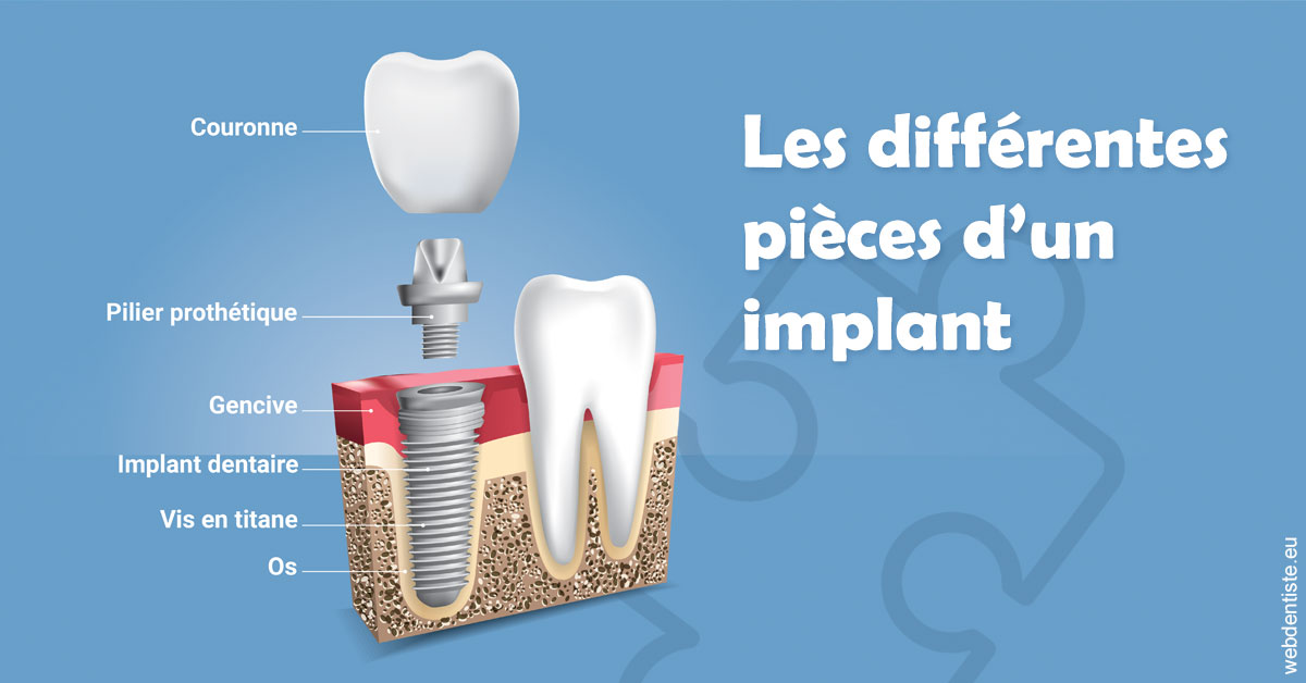 https://dr-maarek-jonathan.chirurgiens-dentistes.fr/Les différentes pièces d’un implant 1
