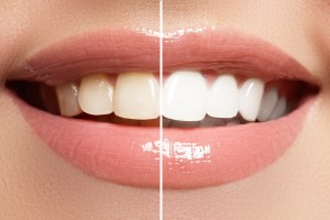 Esthétique dentaire